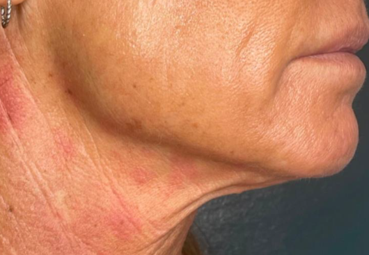Face treatment - after