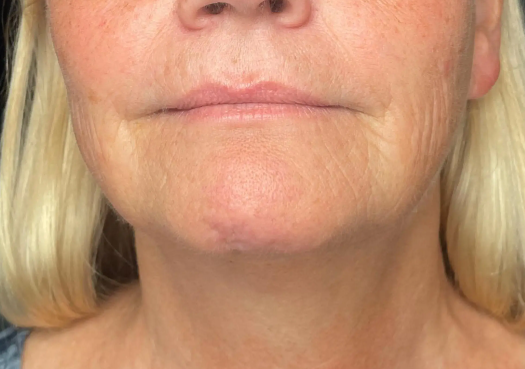 Neck and lower face treatment - after