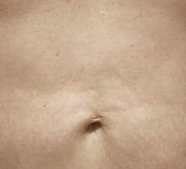 Body treatment - after