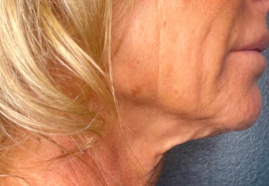 Face treatment - before