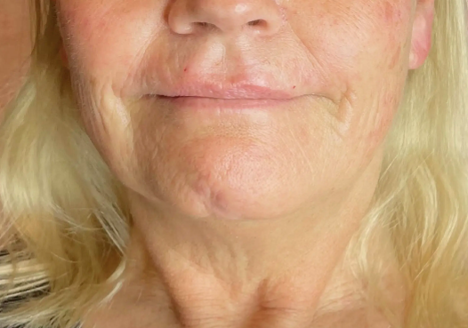 Neck and lower face treatment - before