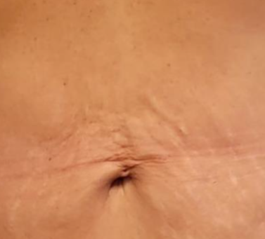 Body treatment - before