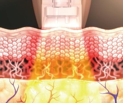Monopolar RF volumetric heating reaching deep tissue