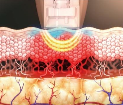 Bipolar RF focused heating in the upper dermis