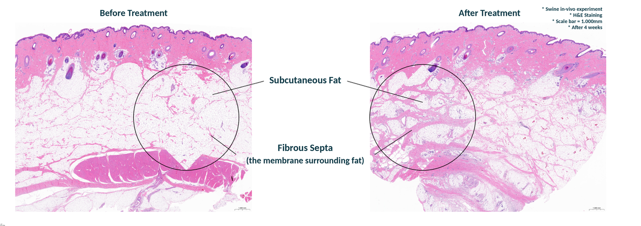 Histology before and after treatment, with the fibrous septa around subcutaneous fat circled